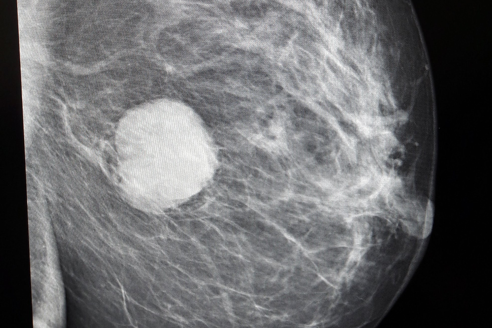 Mammographie von der Seite